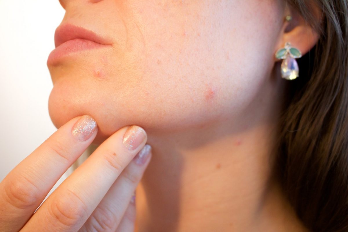 woman with blocked pores and redness